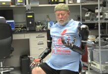 Hombre amputado con brazos bionicos