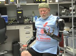 Hombre amputado con brazos bionicos