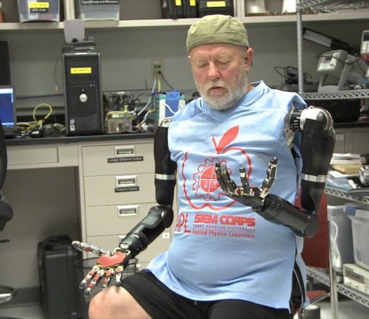 Hombre amputado con brazos bionicos