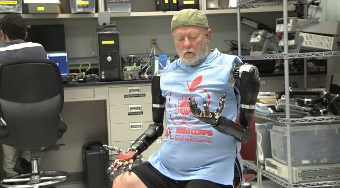 Hombre amputado con brazos bionicos